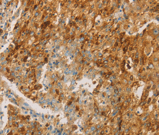 Immunohistochemistry of paraffin-embedded Human gastric cancer tissue using CEACAM8 Polyclonal Antibody at dilution of 1:30