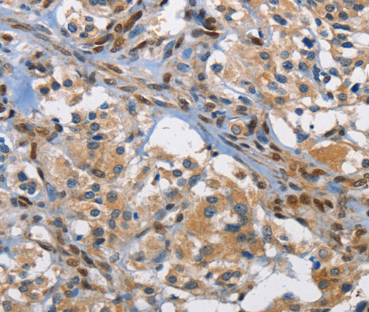 Immunohistochemistry of paraffin-embedded Human thyroid cancer using c-Fos Polyclonal Antibody at dilution of 1:70