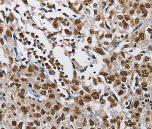 Immunohistochemistry of paraffin-embedded Human esophagus cancer tissue using CMTM2 Polyclonal Antibody at dilution 1:60