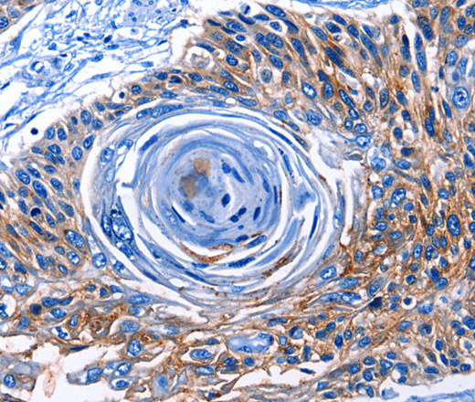 Immunohistochemistry of paraffin-embedded Human esophagus cancer tissue using CLEC2B Polyclonal Antibody at dilution 1:50