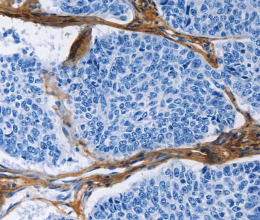 Immunohistochemistry of paraffin-embedded Human lung cancer tissue using COL3A1 Polyclonal Antibody at dilution 1:60