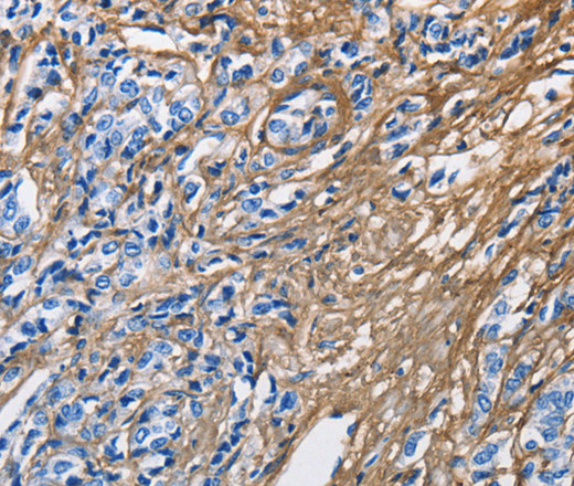 Immunohistochemistry of paraffin-embedded Human prostate cancer tissue using COL3A1 Polyclonal Antibody at dilution 1:60