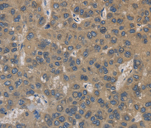 Immunohistochemistry of paraffin-embedded Human liver cancer using EMC8 Polyclonal Antibody at dilution of 1:30