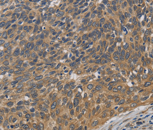 Immunohistochemistry of paraffin-embedded Human cervical cancer using EMC8 Polyclonal Antibody at dilution of 1:30