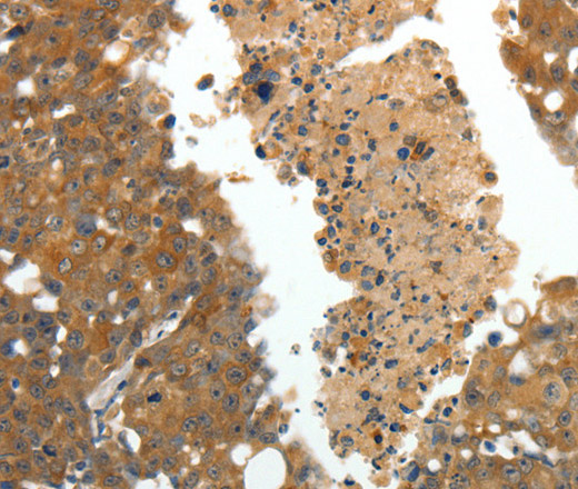 Immunohistochemistry of paraffin-embedded Human breast cancer using CRP Polyclonal Antibody at dilution of 1:80