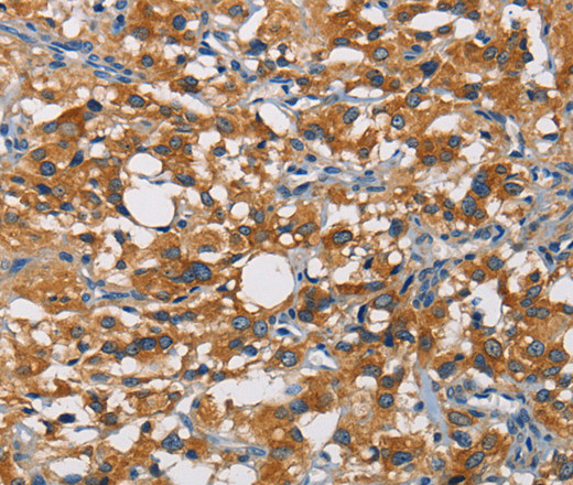 Immunohistochemistry of paraffin-embedded Human thyroid cancer tissue using CRTAM Polyclonal Antibody at dilution of 1:60