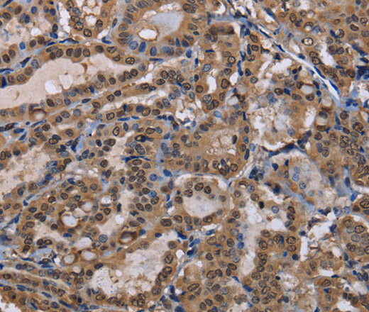 Immunohistochemistry of paraffin-embedded Human thyroid cancer using CUL3 Polyclonal Antibody at dilution of 1:30