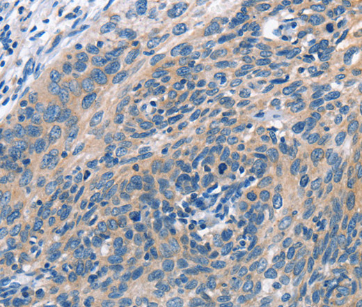 Immunohistochemistry of paraffin-embedded Human cervical cancer tissue using CUL7 Polyclonal Antibody at dilution 1:50