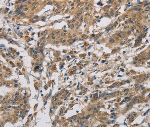 Immunohistochemistry of paraffin-embedded Human gastric cancer using CYCS Polyclonal Antibody at dilution of 1:50