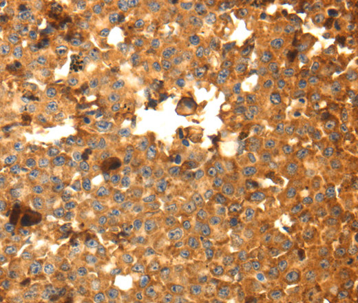 Immunohistochemistry of paraffin-embedded Human breast cancer using DRD5 Polyclonal Antibody at dilution of 1:40