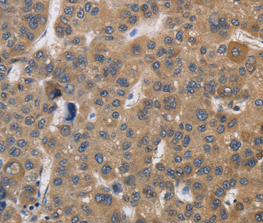 Immunohistochemistry of paraffin-embedded Human liver cancer using SDCCAG3 Polyclonal Antibody at dilution of 1:30