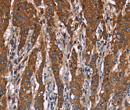 Immunohistochemistry of paraffin-embedded Human gastic cancer using CD107b Polyclonal Antibody at dilution of 1:40