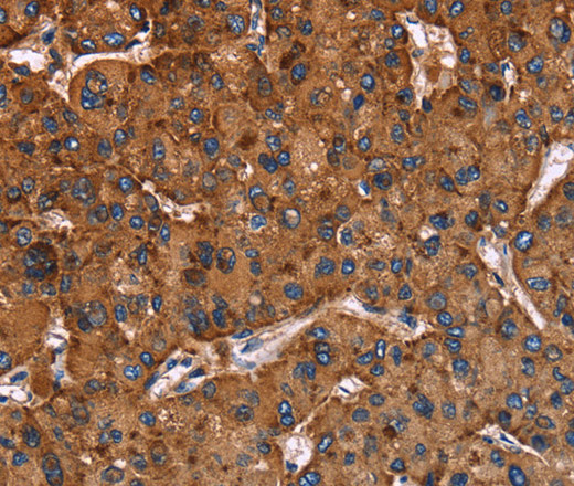 Immunohistochemistry of paraffin-embedded Human liver cancer using CD107b Polyclonal Antibody at dilution of 1:40