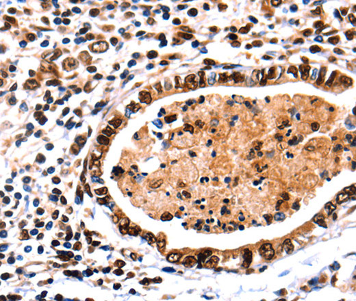 Immunohistochemistry of paraffin-embedded Human stomach cancer tissue using DNMT3A Polyclonal Antibody at dilution 1:65