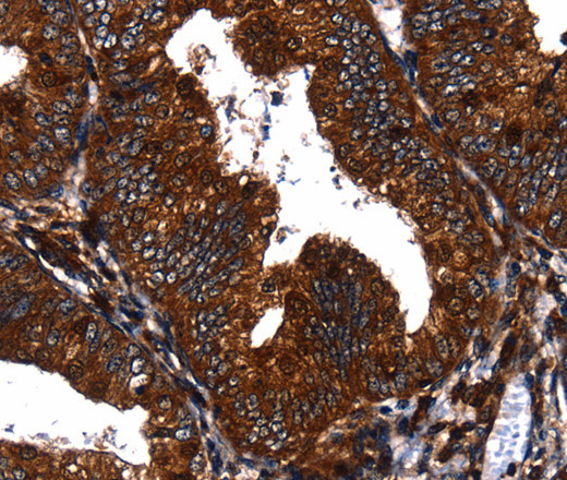 Immunohistochemistry of paraffin-embedded Human cervical cancer tissue using EGF Polyclonal Antibody at dilution 1:60