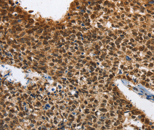 Immunohistochemistry of paraffin-embedded Human lung cancer using ELAVL1 Polyclonal Antibody at dilution of 1:40