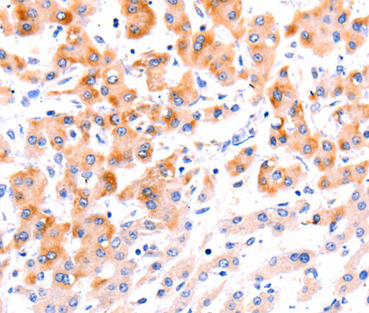 Immunohistochemistry of paraffin-embedded Human liver cancer tissue using Ephrin A1 Polyclonal Antibody at dilution 1:37