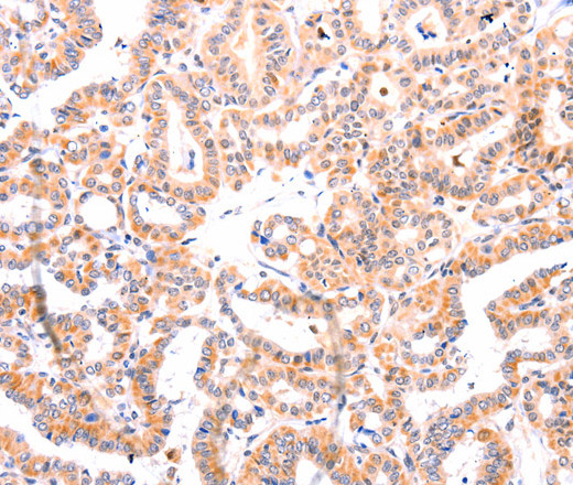 Immunohistochemistry of paraffin-embedded Human thyroid cancer tissue using Ephrin A1 Polyclonal Antibody at dilution 1:37