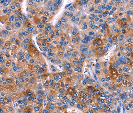 Immunohistochemistry of paraffin-embedded Human liver cancer tissue using DUSP13 Polyclonal Antibody at dilution 1:60