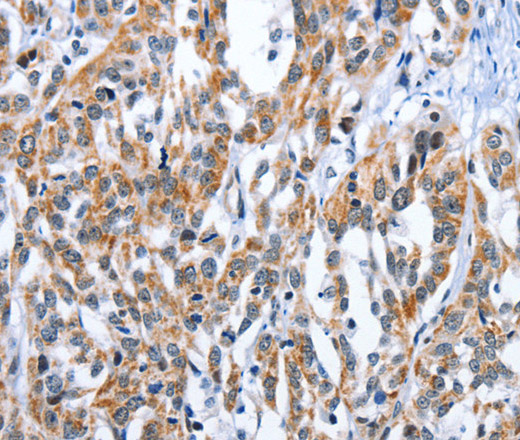 Immunohistochemistry of paraffin-embedded Human esophagus cancer tissue using EDN3 Polyclonal Antibody at dilution 1:30