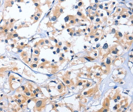 Immunohistochemistry of paraffin-embedded Human thyroid cancer tissue using EDN3 Polyclonal Antibody at dilution 1:30