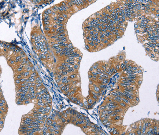 Immunohistochemistry of paraffin-embedded Human cervical cancer tissue using EDN2 Polyclonal Antibody at dilution 1:50
