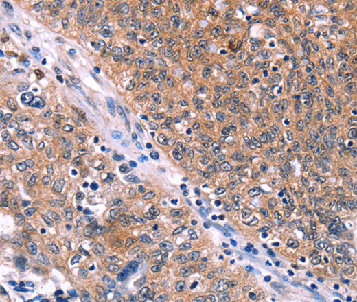 Immunohistochemistry of paraffin-embedded Human ovarian cancer tissue using EDN1 Polyclonal Antibody at dilution 1:50