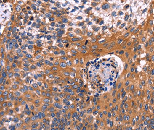 Immunohistochemistry of paraffin-embedded Human cervical cancer using RDX Polyclonal Antibody at dilution of 1:60