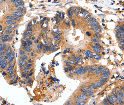 Immunohistochemistry of paraffin-embedded Human colon cancer using FADD Polyclonal Antibody at dilution of 1:35