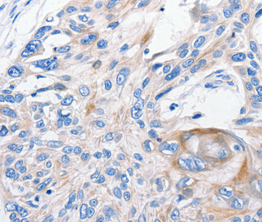 Immunohistochemistry of paraffin-embedded Human esophagus cancer tissue using FANCF Polyclonal Antibody at dilution 1:100