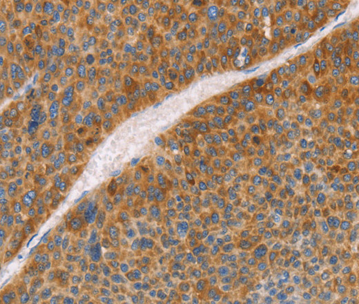 Immunohistochemistry of paraffin-embedded Human liver cancer using FGL1 Polyclonal Antibody at dilution of 1:50