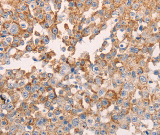 Immunohistochemistry of paraffin-embedded Human breast cancer using GNA11 Polyclonal Antibody at dilution of 1:40