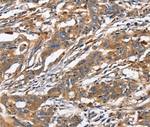 Immunohistochemistry of paraffin-embedded Human gastric cancer using GNA13 Polyclonal Antibody at dilution of 1:30