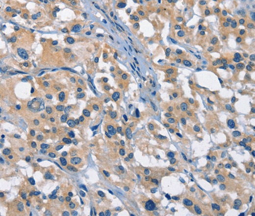 Immunohistochemistry of paraffin-embedded Human thyroid cancer tissue using GAS2 Polyclonal Antibody at dilution 1:50