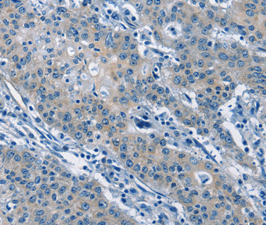 Immunohistochemistry of paraffin-embedded Human gastric cancer tissue using GAS2 Polyclonal Antibody at dilution 1:50