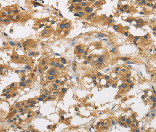 Immunohistochemistry of paraffin-embedded Human thyroid cancer using GAS7 Polyclonal Antibody at dilution of 1:50