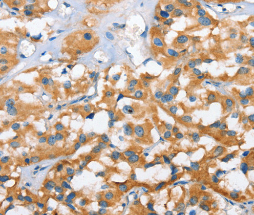 Immunohistochemistry of paraffin-embedded Human thyroid cancer tissue using CXCL14 Polyclonal Antibody at dilution 1:40