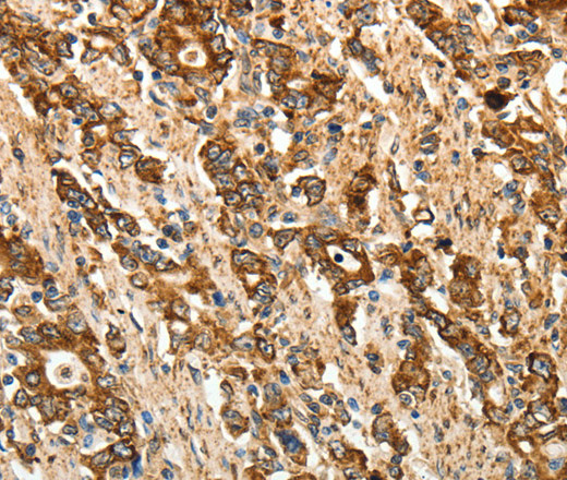 Immunohistochemistry of paraffin-embedded Human gastic cancer using CALR Polyclonal Antibody at dilution of 1:50