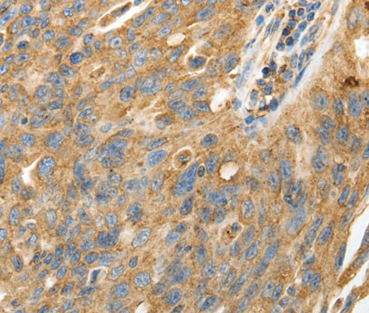 Immunohistochemistry of paraffin-embedded Human ovarian cancer using CALR Polyclonal Antibody at dilution of 1:50