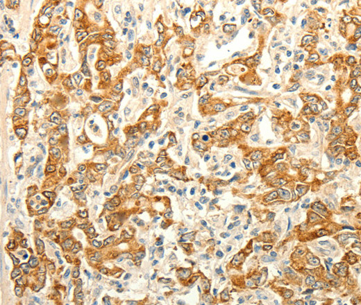 Immunohistochemistry of paraffin-embedded Human gasrtic cancer tissue using ERG Polyclonal Antibody at dilution 1:30