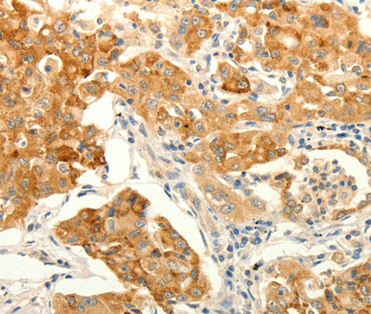 Immunohistochemistry of paraffin-embedded Human lung cancer tissue using ERG Polyclonal Antibody at dilution 1:30