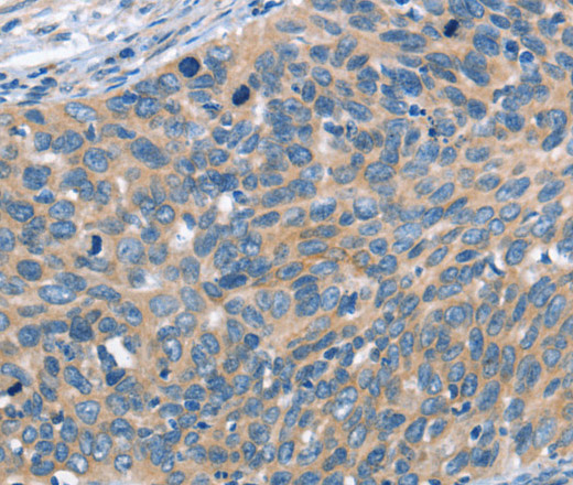 Immunohistochemistry of paraffin-embedded Human cervical cancer tissue using SCARB1 Polyclonal Antibody at dilution 1:60