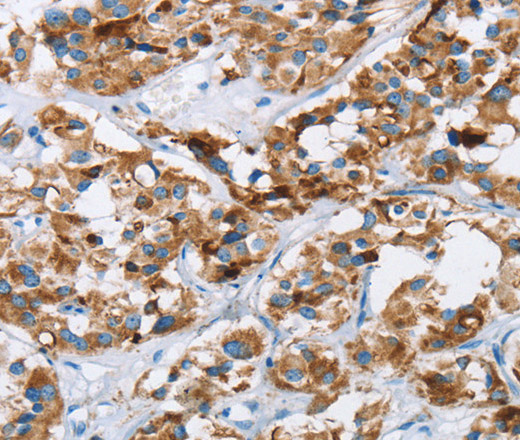 Immunohistochemistry of paraffin-embedded Human thyroid cancer tissue using HINT2 Polyclonal Antibody at dilution 1:40