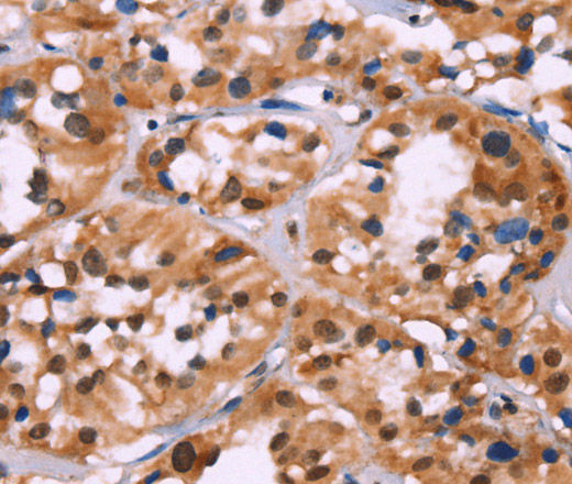 Immunohistochemistry of paraffin-embedded Human thyroid cancer tissue using HIST1H1C Polyclonal Antibody at dilution 1:70