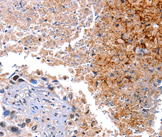 Immunohistochemistry of paraffin-embedded Human lung cancer tissue using HMOX1 Polyclonal Antibody at dilution 1:40