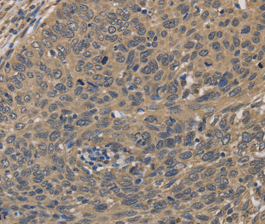 Immunohistochemistry of paraffin-embedded Human cervical cancer tissue using HSF1 Polyclonal Antibody at dilution 1:60