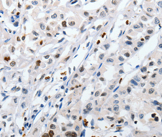 Immunohistochemistry of paraffin-embedded Human lung cancer tissue using HSPA1A Polyclonal Antibody at dilution 1:60