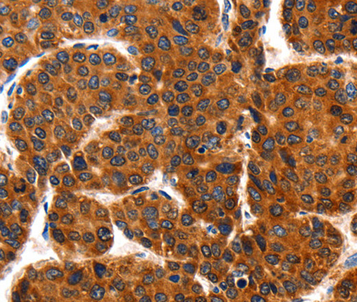 Immunohistochemistry of paraffin-embedded Human liver cancer using HSP75 Polyclonal Antibody at dilution of 1:100