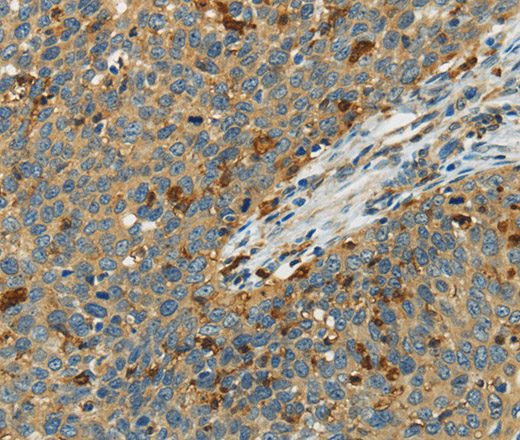 Immunohistochemistry of paraffin-embedded Human cervical cancer using AIF1 Polyclonal Antibody at dilution of 1:40