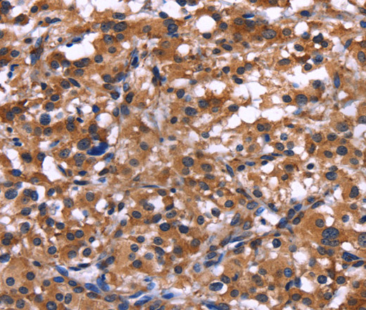 Immunohistochemistry of paraffin-embedded Human thyroid cancer tissue using IL1A Polyclonal Antibody at dilution 1:40